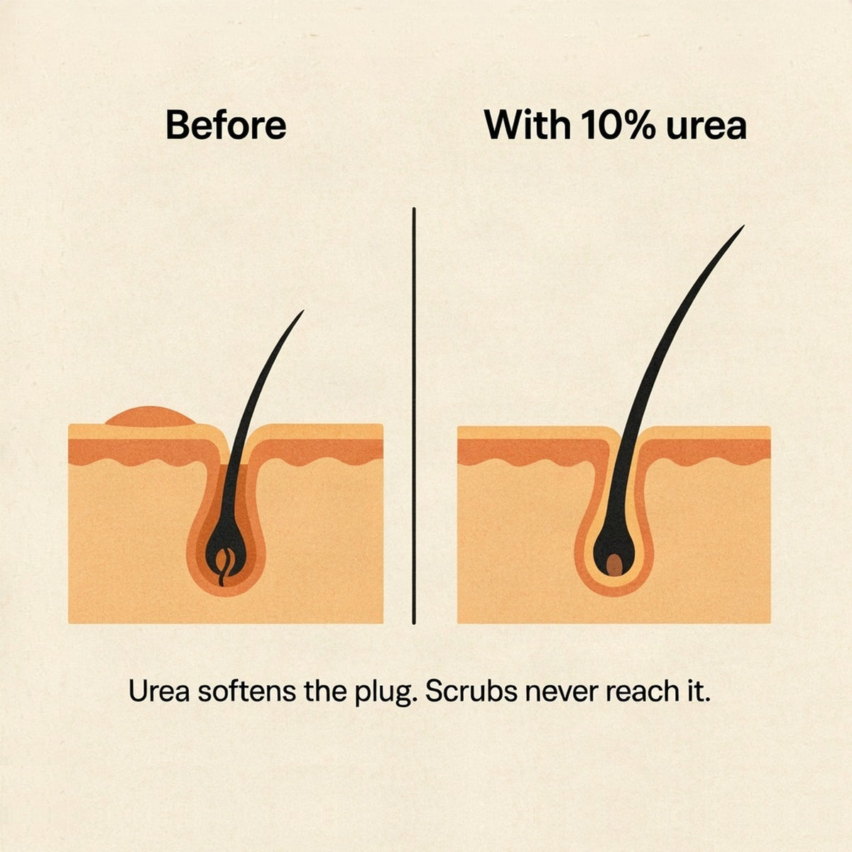 Diagram: keratin plug inside the follicle, before and with 10% urea